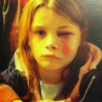 Junior Alex Abresch is shown with a black eye and bruised face after the car accident when she was 8 years old.